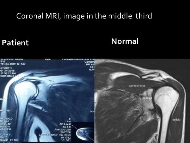 Rotator cuff