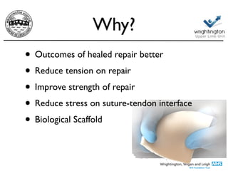 Why?
• Outcomes of healed repair bette
r

• Reduce tension on repai
r

• Improve strength of repai
r

• Reduce stress on suture-tendon interfac
e

• Biological Scaffold
 