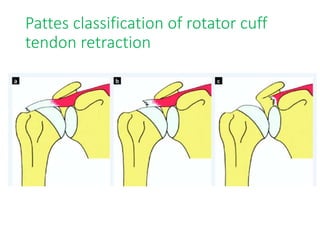 Sade Classification Rotator cuff disorders, bicipital tendinopathies | PPTX