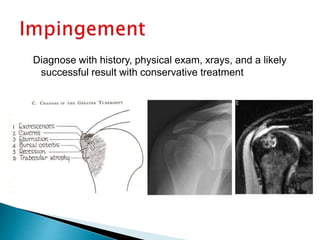 Diagnose with history, physical exam, xrays, and a likely
successful result with conservative treatment
 
