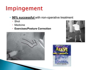 • 90% successful with non-operative treatment
 Shot
 Medicine
 Exercises/Posture Correction
 
