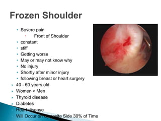 • Severe pain
 Front of Shoulder
• constant
• stiff
• Getting worse
• May or may not know why
• No injury
• Shortly after minor injury
• following breast or heart surgery
 40 - 60 years old
 Women > Men
 Thyroid disease
 Diabetes
 Heart disease
 Will Occur on Opposite Side 30% of Time
 