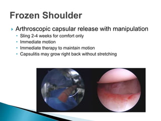  Arthroscopic capsular release with manipulation
• Sling 2-4 weeks for comfort only
• Immediate motion
• Immediate therapy to maintain motion
• Capsulitis may grow right back without stretching
 