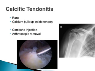• Rare
• Calcium buildup inside tendon
• Cortisone injection
• Arthroscopic removal
 