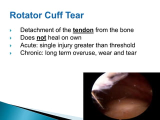  Detachment of the tendon from the bone
 Does not heal on own
 Acute: single injury greater than threshold
 Chronic: long term overuse, wear and tear
 
