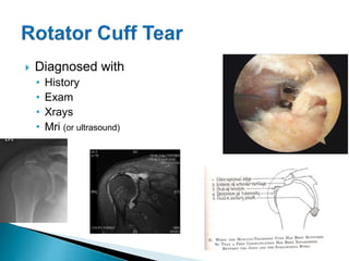  Diagnosed with
• History
• Exam
• Xrays
• Mri (or ultrasound)
 