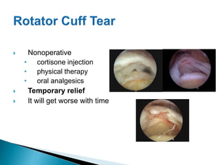  Nonoperative
• cortisone injection
• physical therapy
• oral analgesics
 Temporary relief
 It will get worse with time
 