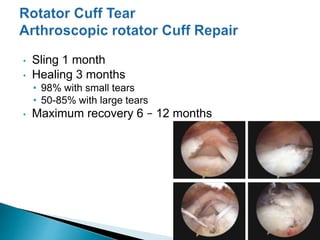 • Sling 1 month
• Healing 3 months
• 98% with small tears
• 50-85% with large tears
• Maximum recovery 6 – 12 months
 