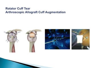 Rotator cuff disorder