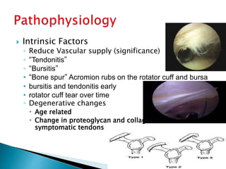  Intrinsic Factors
◦ Reduce Vascular supply (significance)
◦ “Tendonitis”
◦ “Bursitis”
• “Bone spur” Acromion rubs on the rotator cuff and bursa
• bursitis and tendonitis early
• rotator cuff tear over time
◦ Degenerative changes
 Age related
 Change in proteoglycan and collagen content in
symptomatic tendons
 