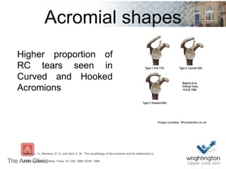 Acromial shapes
Bigliani, L. U.; Morrison, D. S.; and April, E. W.: The morphology of the acromion and its relationship to
rotator cuff tears. Orthop. Trans.,10: 228, 1986.10228 1986
Higher proportion of
RC tears seen in
Curved and Hooked
Acromions
Image courtesy- Shoulderdoc.co.uk
 