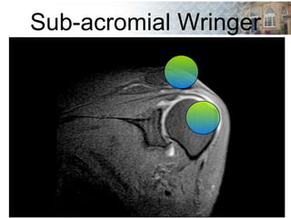 Sub-acromial Wringer
 