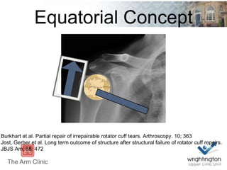 Equatorial Concept
Burkhart et al. Partial repair of irrepairable rotator cuff tears. Arthroscopy. 10; 363
Jost, Gerber et al. Long term outcome of structure after structural failure of rotator cuff repairs.
JBJS Am; 88: 472
 