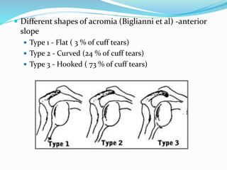  Different shapes of acromia (Biglianni et al) -anterior
slope
 Type 1 - Flat ( 3 % of cuff tears)
 Type 2 - Curved (24 % of cuff tears)
 Type 3 - Hooked ( 73 % of cuff tears)
 