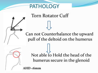 PATHOLOGY
Torn Rotator Cuff
Can not Counterbalance the upward
pull of the deltoid on the humerus
Not able to Hold the head of the
humerus secure in the glenoid
AHD <6mm
 