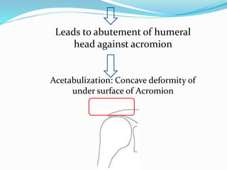 Leads to abutement of humeral
head against acromion
Acetabulization: Concave deformity of
under surface of Acromion
 