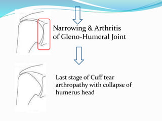 Narrowing & Arthritis
of Gleno-Humeral Joint
Last stage of Cuff tear
arthropathy with collapse of
humerus head
 