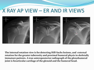 X RAY AP VIEW – ER AND IR VIEWS
The internal rotation view is for detecting Hill-Sachs lesions, and external
rotation for the greater tuberosity and proximal humeral physis in skeletally
immature patients. A true anteroposterior radiograph of the glenohumeral
joint is forarticular cartilage of the glenoid and the humeral head.
 