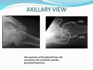AXILLARY VIEW
the anatomy of the glenoid rim, the
acromion, the coracoid, and the
proximal humerus.
 