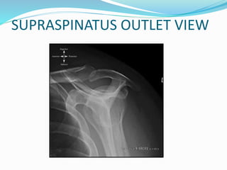 SUPRASPINATUS OUTLET VIEW
 