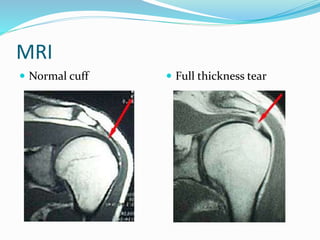 MRI
 Normal cuff  Full thickness tear
 