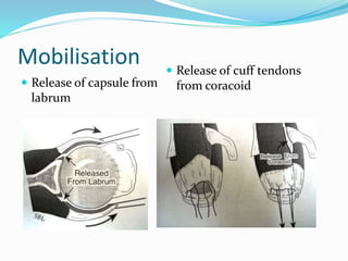 Mobilisation
 Release of capsule from
labrum
 Release of cuff tendons
from coracoid
 