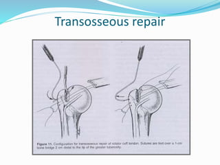 Transosseous repair
 