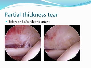 Partial thickness tear
 Before and after debridement
 