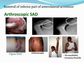 Arthroscopic SAD
Removal of inferior part of anterolateral acromion
Open SAD • No morbidity
• Genuine benefit
Arthroscopic
 