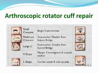 Arthroscopic rotator cuff repair
 