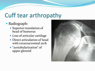 Cuff tear arthropathy
 Radiograph:
 Superior translation of
head of humerus
 Loss of articular cartilage
 Direct articulation of head
with coracoacromial arch
 “acetabularization” of
upper glenoid
 
