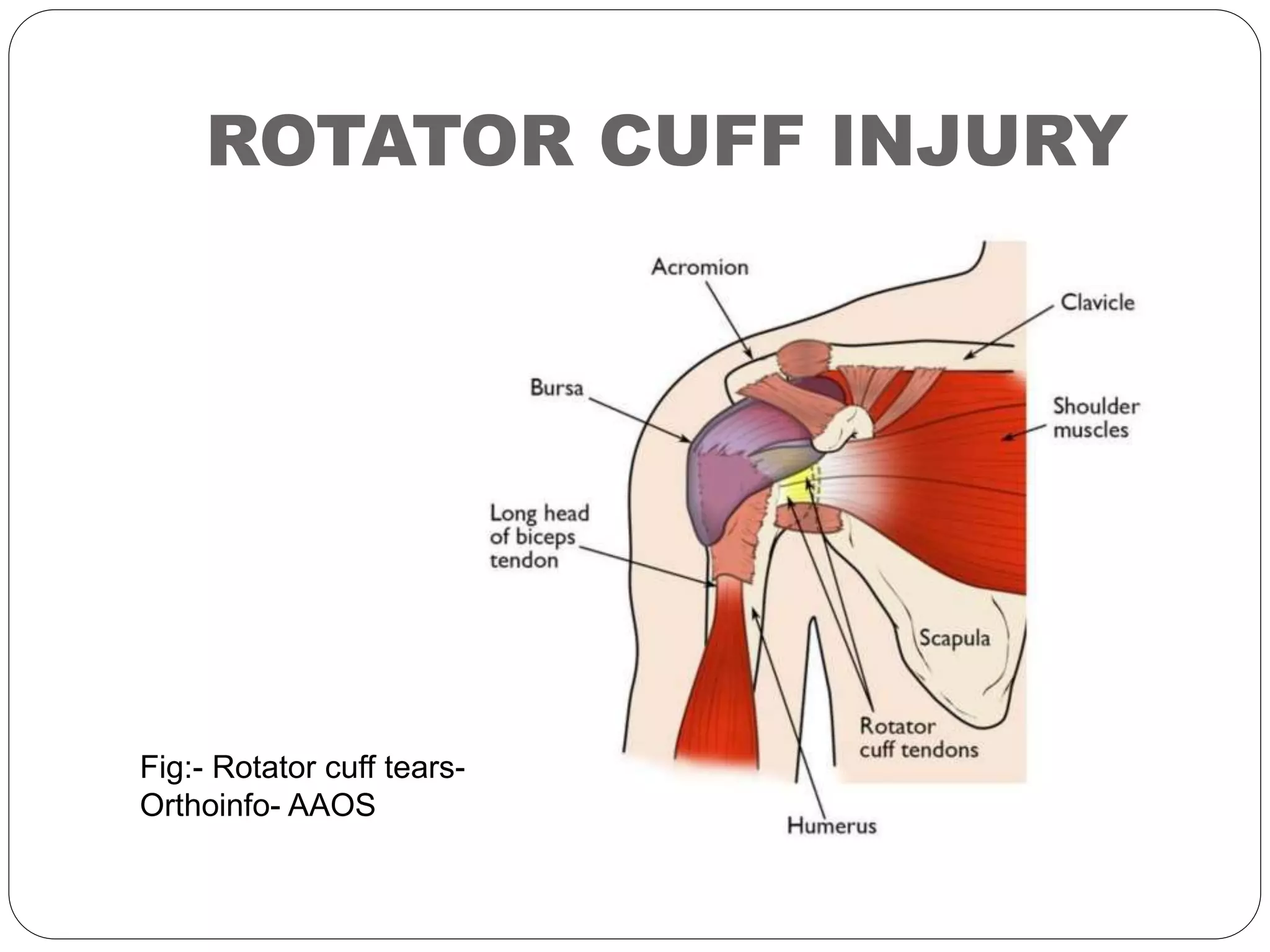 Rotary Cuff Rotator cuff injuries | PPTX