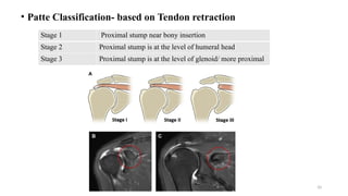 Patte Classification Radiology Comprehensive Overview of Rotator Cuff Injury: Anatomy, Diagnosis, and ...