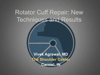 Rotator Cuff Repair: New
Techniques and Results
Vivek Agrawal, MD
The Shoulder Center
Carmel, IN
 