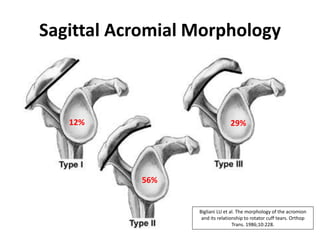 Sagittal Acromial Morphology
12%
56%
29%
Bigliani LU et al. The morphology of the acromion
and its relationship to rotator cuff tears. Orthop
Trans. 1986;10:228.
 