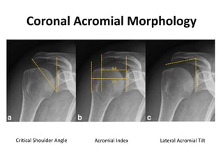 Coronal Acromial Morphology
Critical Shoulder Angle Acromial Index Lateral Acromial Tilt
 