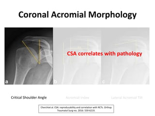 Coronal Acromial Morphology
Critical Shoulder Angle Acromial Index Lateral Acromial Tilt
CSA correlates with pathology
Cherchiet al. CSA: reproducability and correlation with RCTs. Orthop
Traumatol Surg res. 2016: 559-6219.
 