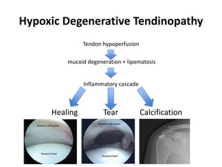 Hypoxic Degenerative Tendinopathy
Tendon hypoperfusion
mucoid degeneration + lipomatosis
Inflammatory cascade
Healing Tear Calcification
 