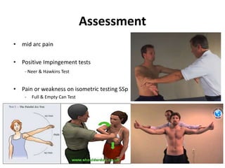 Assessment
• mid arc pain
• Positive Impingement tests
- Neer & Hawkins Test
• Pain or weakness on isometric testing SSp
- Full & Empty Can Test
 