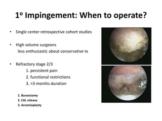 1o Impingement: When to operate?
• Single center retrospective cohort studies
• High volume surgeons
less enthusiastic about conservative tx
• Refractory stage 2/3
1. persistent pain
2. functional restrictions
3. >3 months duration
1. Bursectomy
2. CAL release
3. Acromioplasty
 