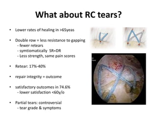 What about RC tears?
• Lower rates of healing in >65yeas
• Double row = less resistance to gapping
- fewer retears
- symtiomatically SR=DR
- Less strength, same pain scores
• Retear: 17%-40%
• repair integrity = outcome
• satisfactory outcomes in 74.6%
- lower satisfaction <60y/o
• Partial tears: controversial
- tear grade & symptoms
 