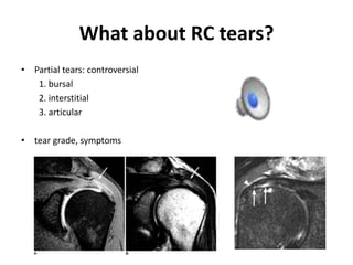 What about RC tears?
• Partial tears: controversial
1. bursal
2. interstitial
3. articular
• tear grade, symptoms
 
