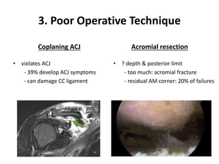 3. Poor Operative Technique
Coplaning ACJ
• violates ACJ
- 39% develop ACJ symptoms
- can damage CC ligament
Acromial resection
• ? depth & posterior limit
- too much: acromial fracture
- residual AM corner: 20% of failures
 