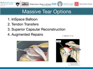 Massive Tear Options
1. InSpace Balloon

2. Tendon Transfers

3. Superior Capsular Reconstruction

4. Augmented Repairs
 
