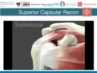 Superior Capsular Recon
 