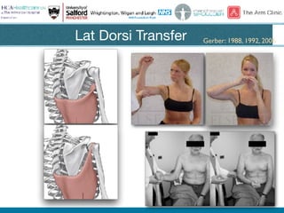 Lat Dorsi Transfer Gerber: 1988, 1992, 2006
 