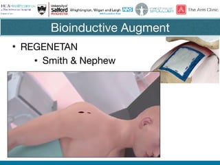 Bioinductive Augment
• REGENETAN

• Smith & Nephew
 