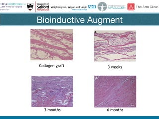 Bioinductive Augment
Collagen graft 3 weeks
3 months 6 months
 