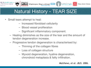 Natural History - TEAR SIZE
• Small tears attempt to heal:

– Increased fibroblast cellularity

– Blood vessel proliferation 

– Significant inflammatory component. 

– Healing diminishes as the size of the tear and the amount of
tendon degeneration increase. 

– Progressive tendon degeneration is characterised by:

– Thinning of the collagen fibres

– Loss of collagen structure

– Myxoid degeneration, hyaline degeneration,
chrondroid metaplasia & fatty infiltration.
Matthews, et al. JBJS. 2006.
 