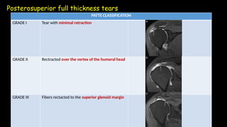 Patte Classification Radiology ROTATOR CUFF TEAR PATTERNS and normal.pptx